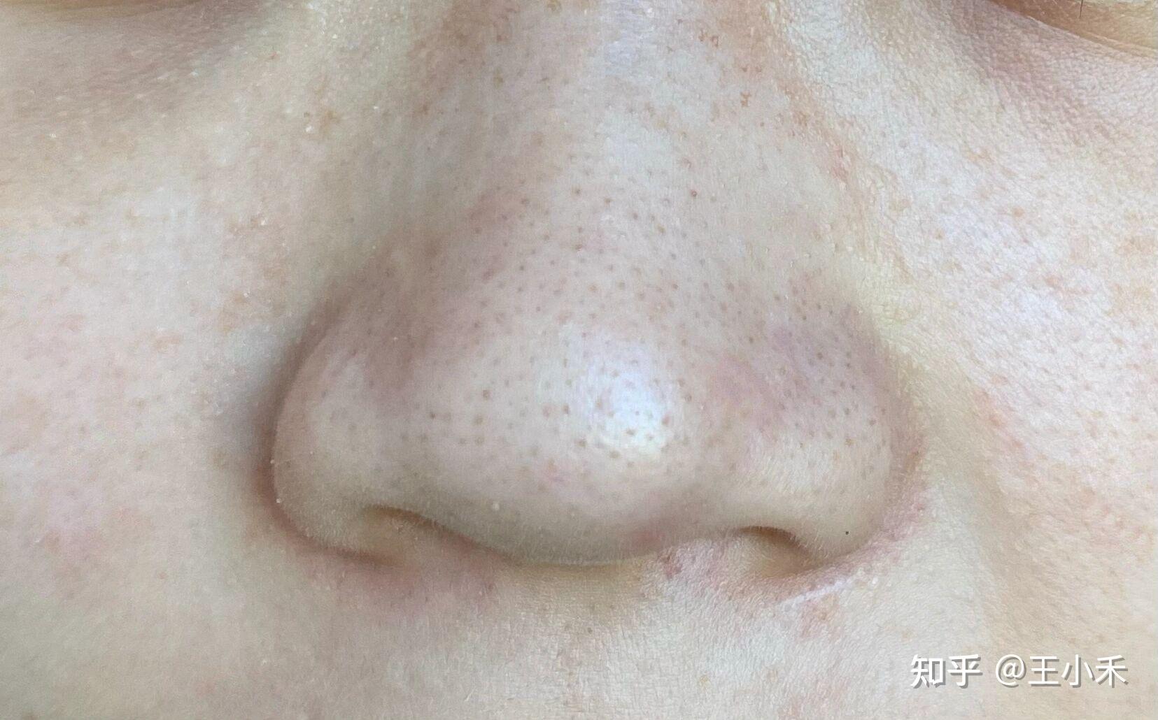 脸上的黑头毛孔非常多,密密麻麻的满鼻子都是,又黑又干又硬特别难看!