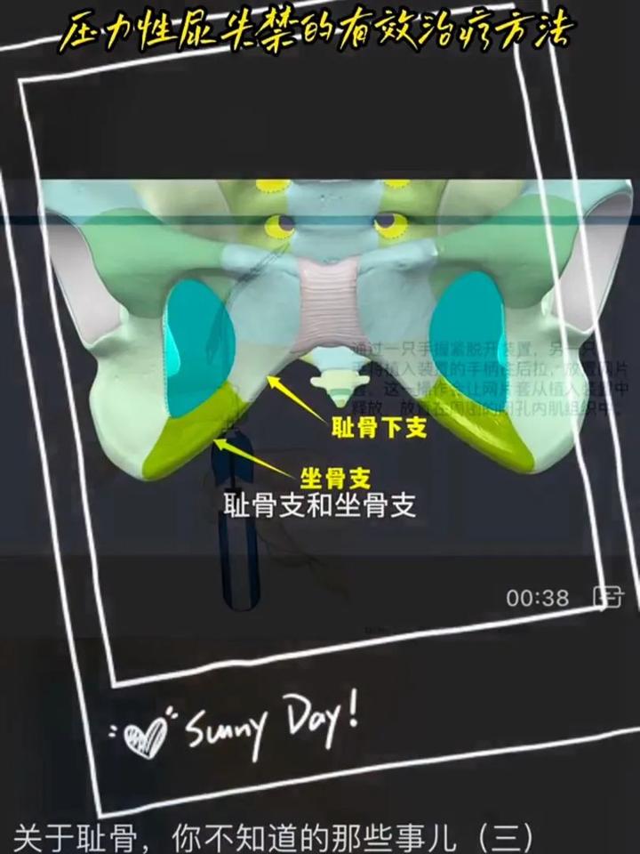 尿失禁/漏尿，治疗有方法！ - 知乎