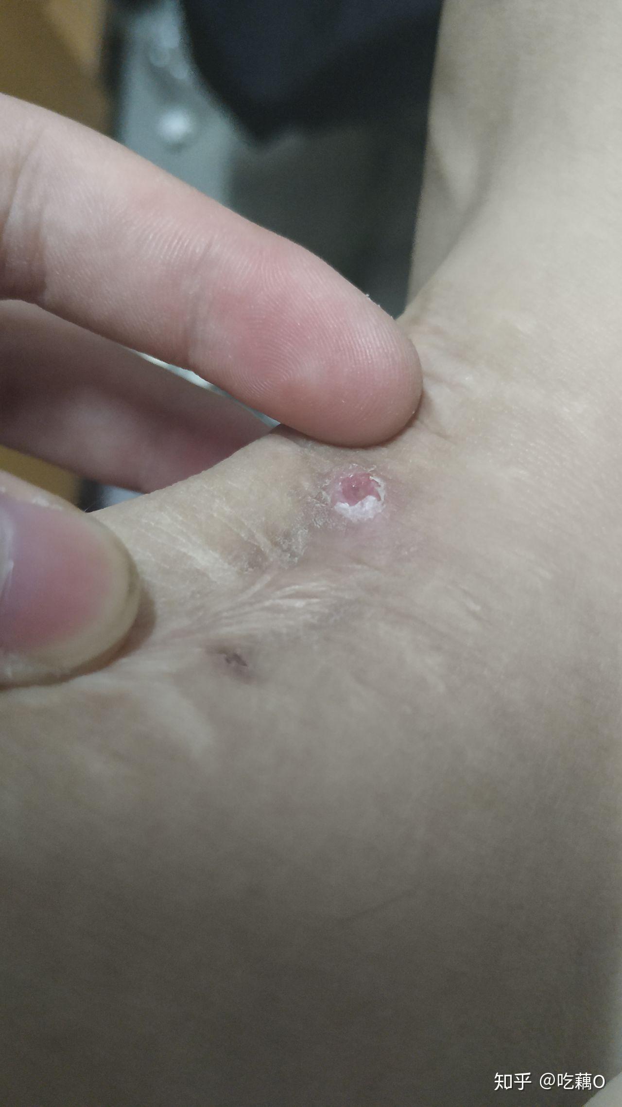 请问手术拆线后针眼里有线头正常吗? - 知乎