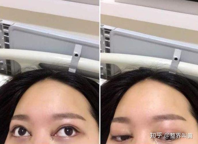 请问我一个眼睛歪的问题怎么调整