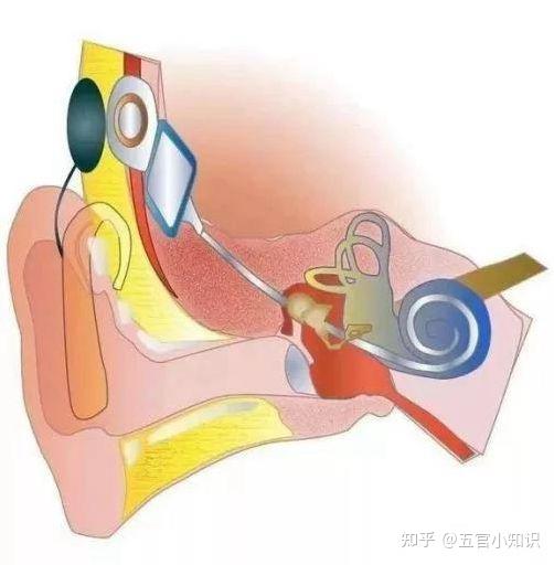 人工耳蜗植入体图片