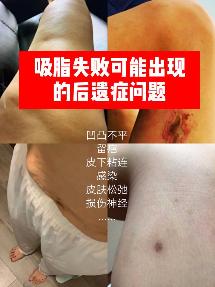吸脂失败可能出现哪些后遗症