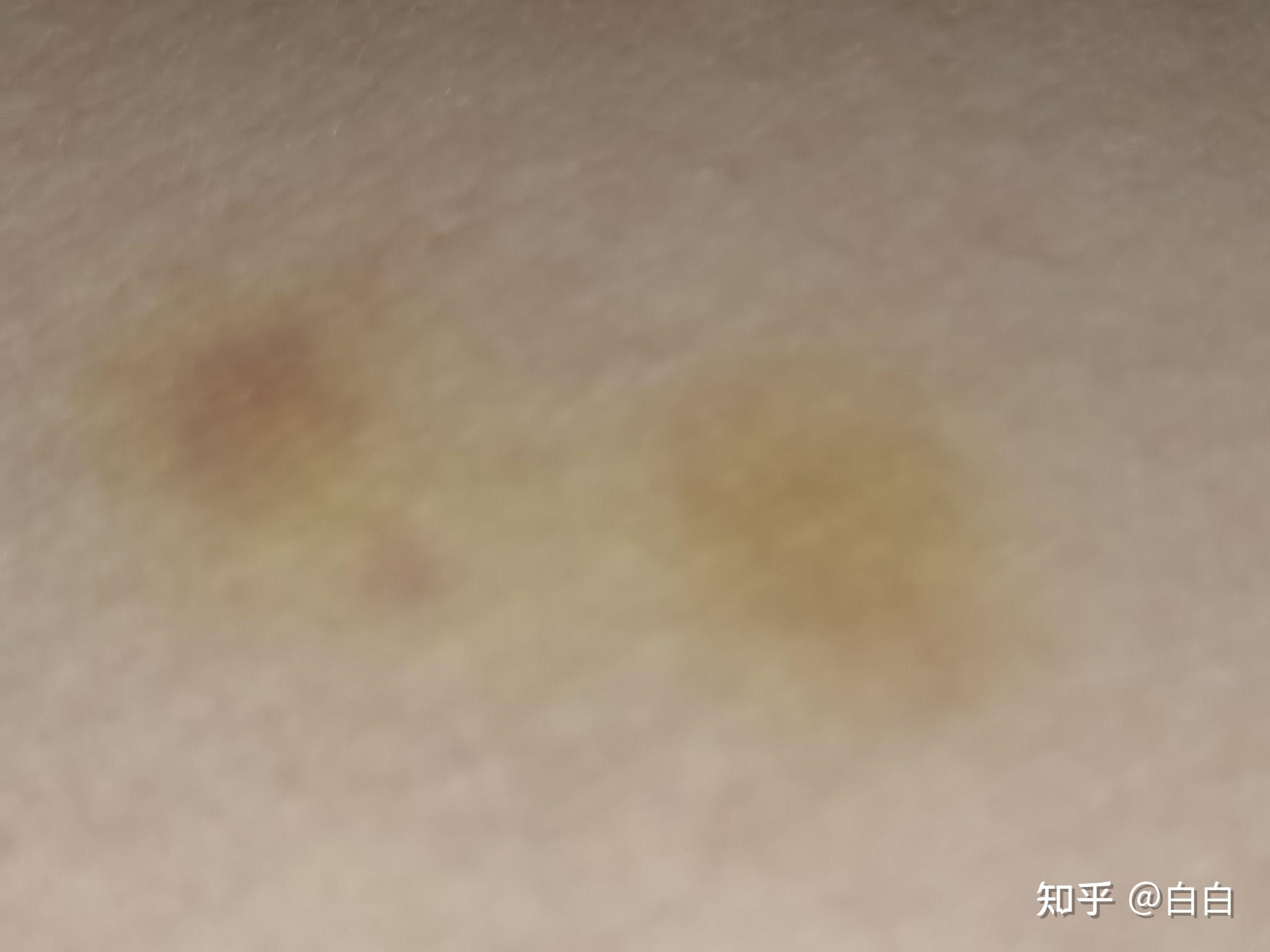 皮肤突然出现黄块