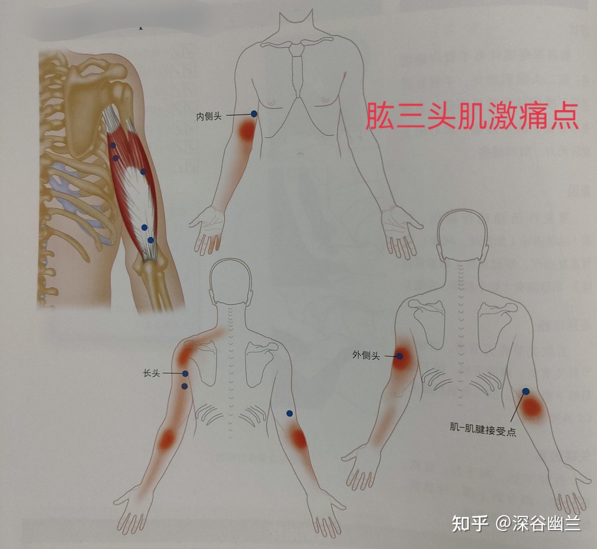 肱二头肌激痛点牵涉痛位于长头肌腱表面的椭圆区域局部剧烈疼痛,疼痛
