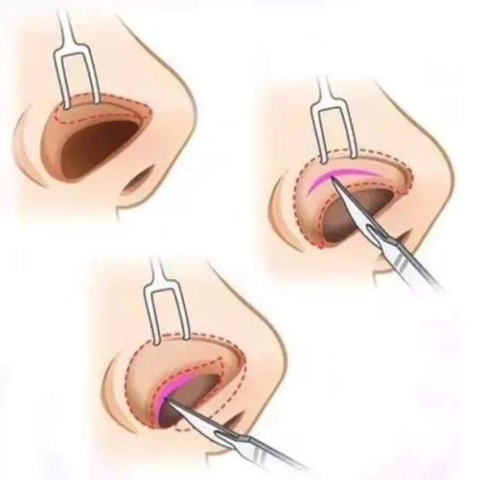 隆鼻的切口你知道在哪里吗