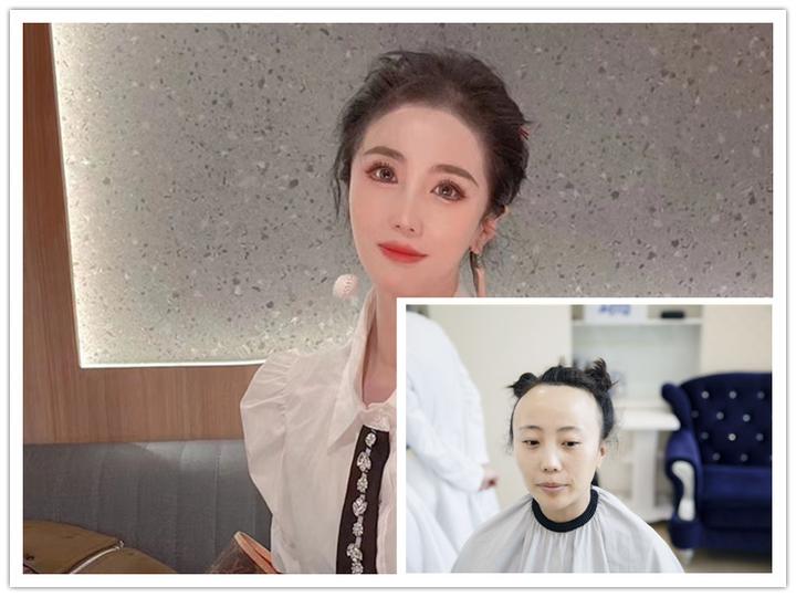 挑战全网蕞大女性植发数量，种植4800单位的大脑门是什么样？！ - 知乎