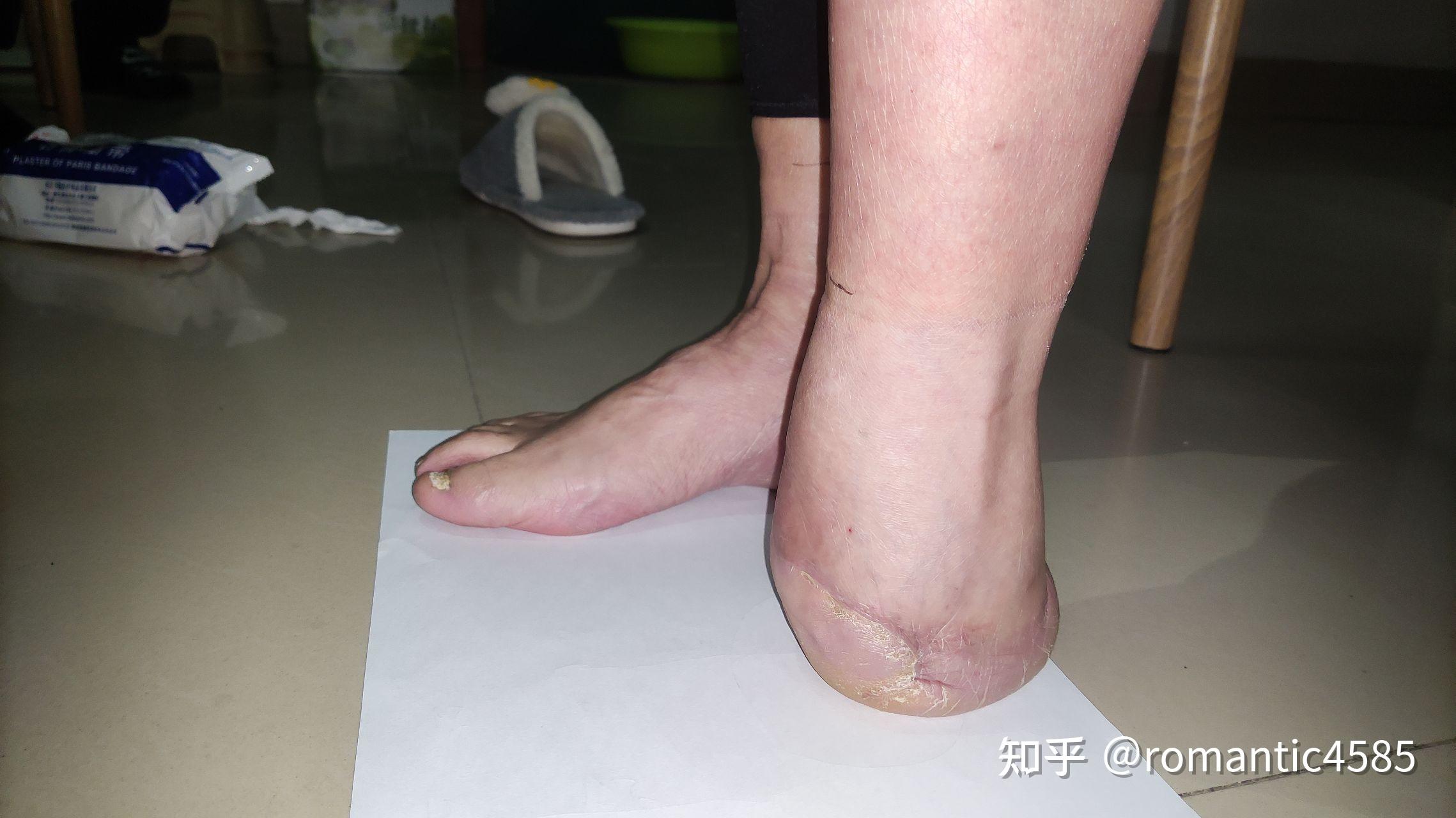 一例半足截肢患者制作硅胶拉链假肢的制作流程介绍