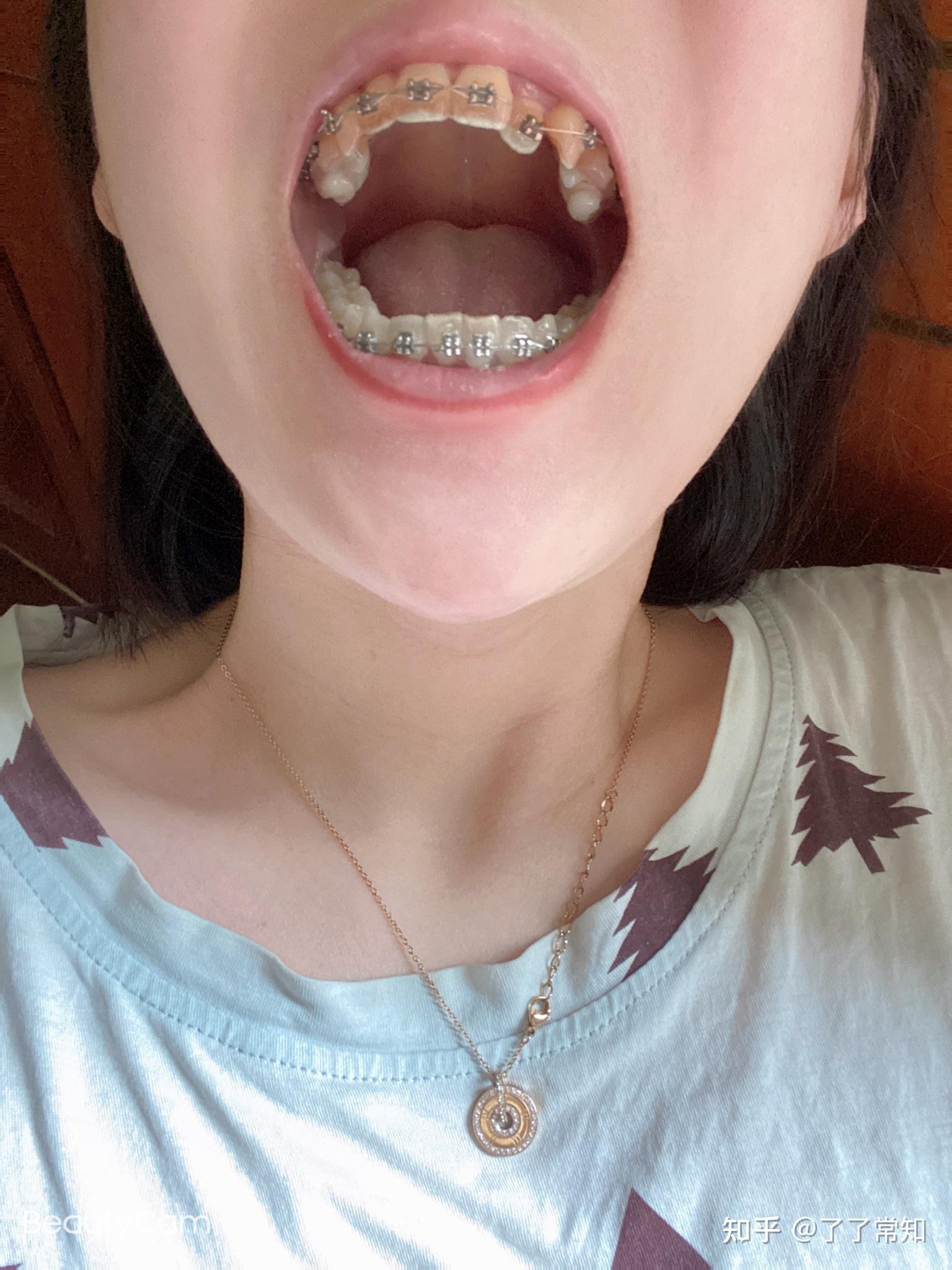 记录贴虎牙拥挤矫正