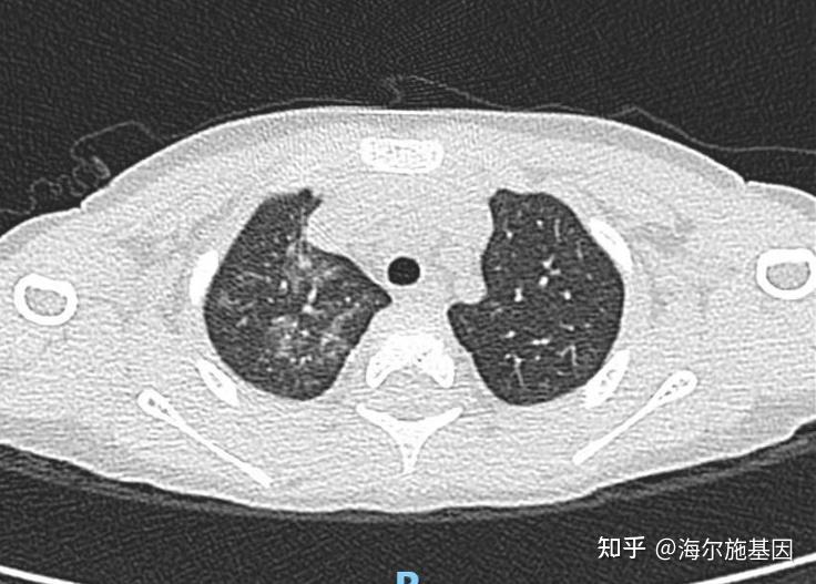 病例分享一例毛细支气管炎的诊疗