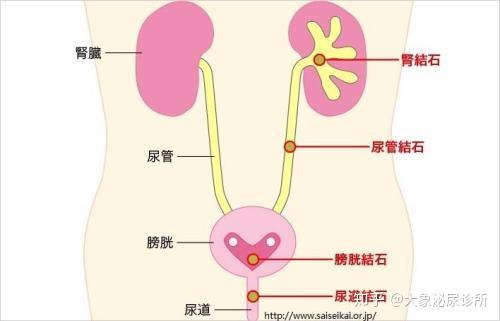 正确认识泌尿系结石