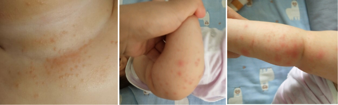 宝宝出现痱子,在接诊中最常见的原因有以下几种:大腿/膝盖等褶皱处没
