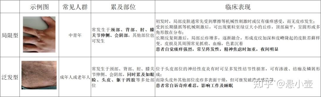 最新神经性皮炎基层诊疗指南拆解 - 知乎