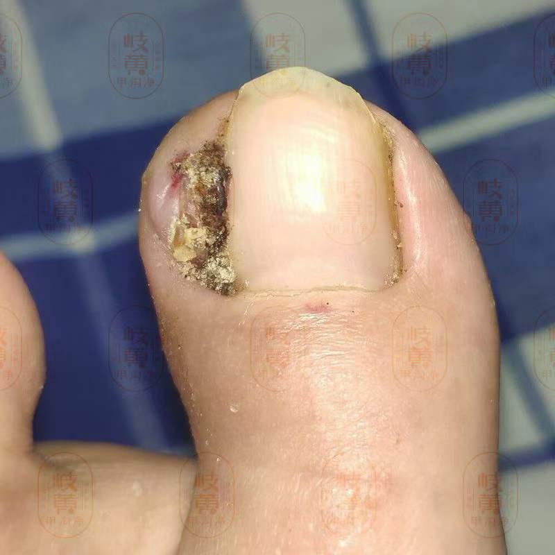 原先是甲沟炎,自行剪甲后长了肉芽,且越来越大,怎么办? - 知乎