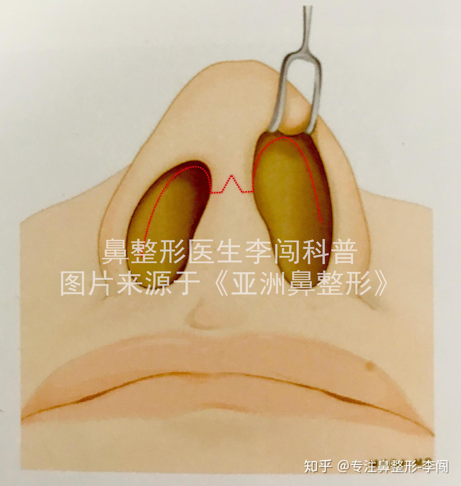 鼻小柱切口易留疤隆鼻能选择鼻内切口吗