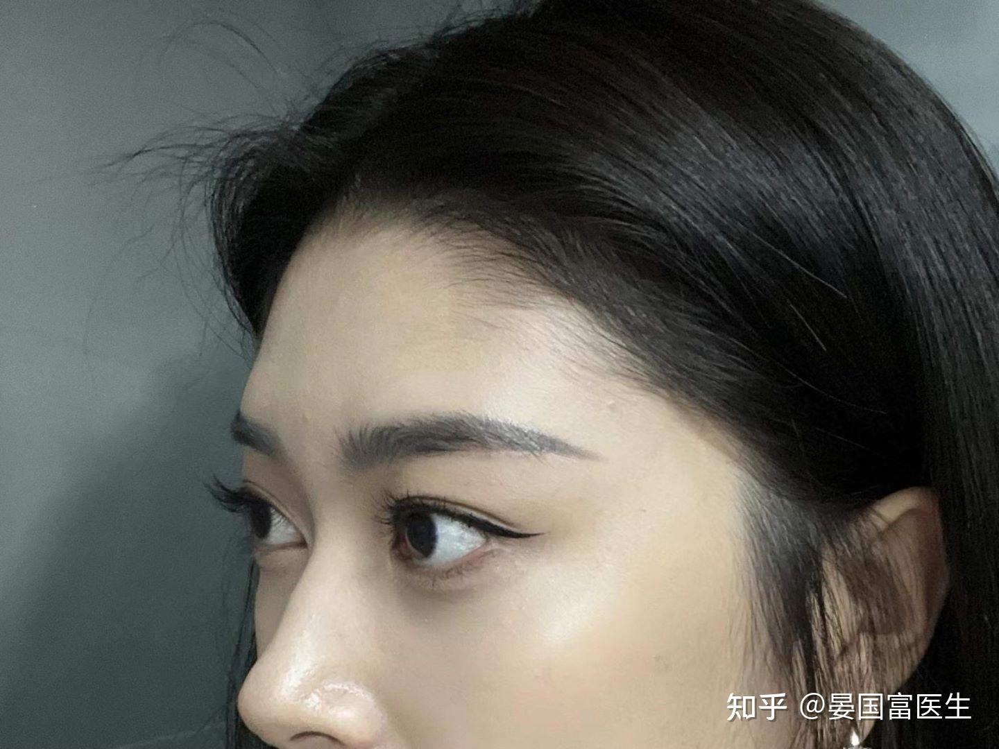 眼睛戴眼镜变形之后可以做埋线吗? - 知乎