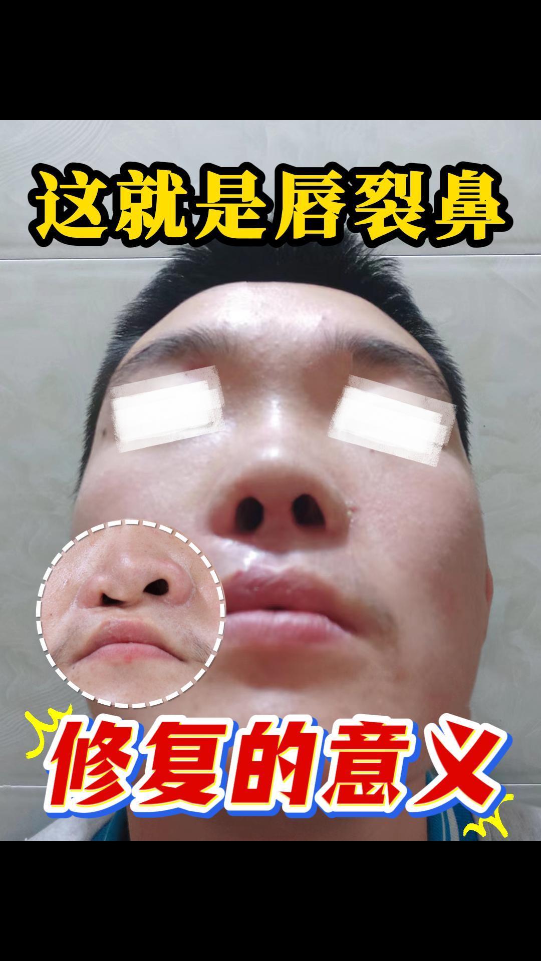 这就是唇裂鼻修复的意义