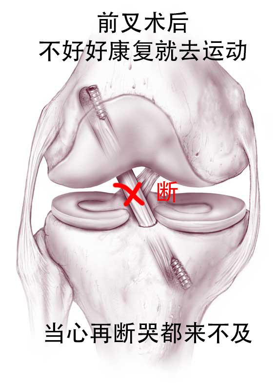 叉友注意:前交叉韧带重建手术做完后,别得瑟,当心还会断 - 知乎