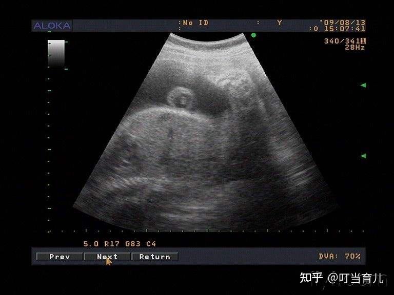 在一次产检中,李女士腹中的胎儿却被诊断为"海豹胎"