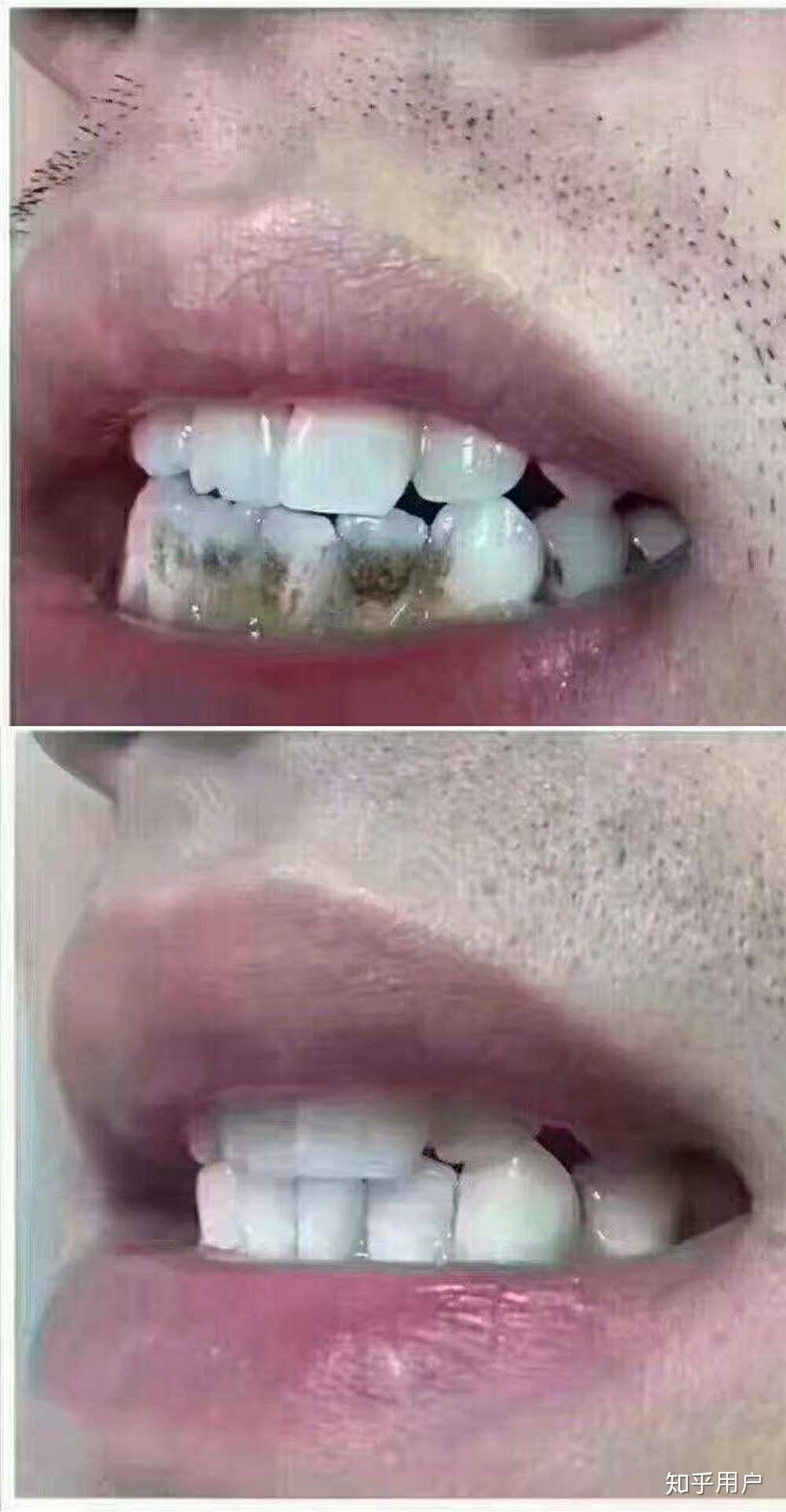 牙结石和牙菌斑的区别