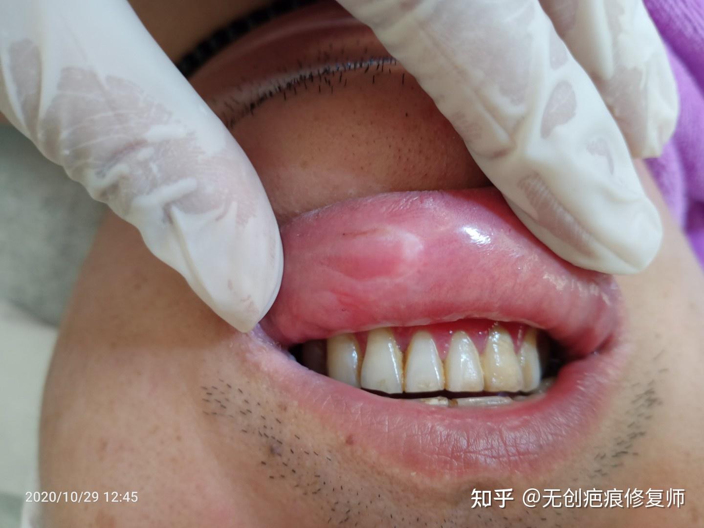 m唇术后疤痕增生? - 知乎