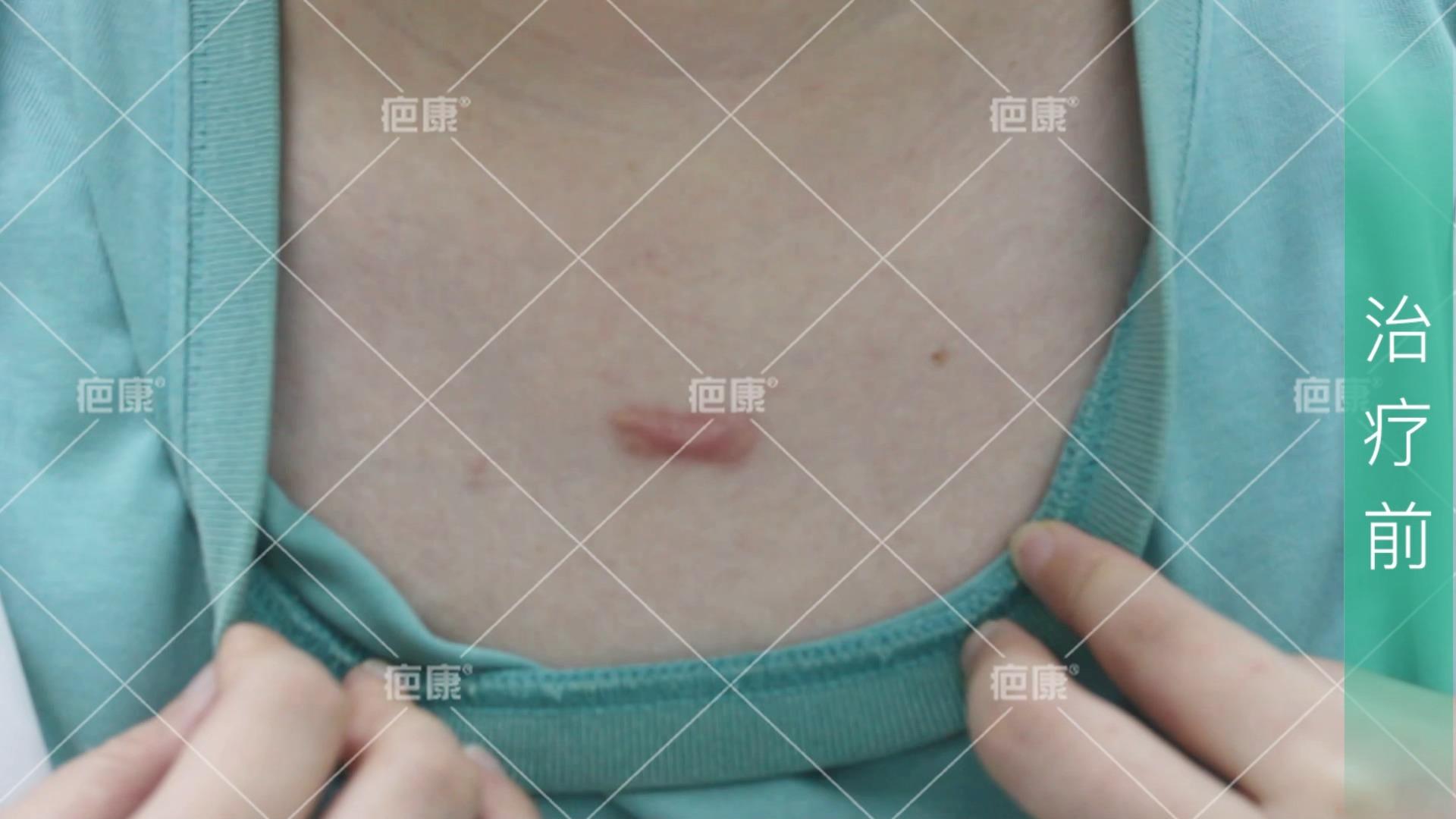 前胸毛囊炎凸起疤痕疙瘩