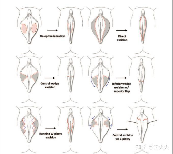 女性私密整形手术有哪几种方式?有效吗?今天全都告诉你!