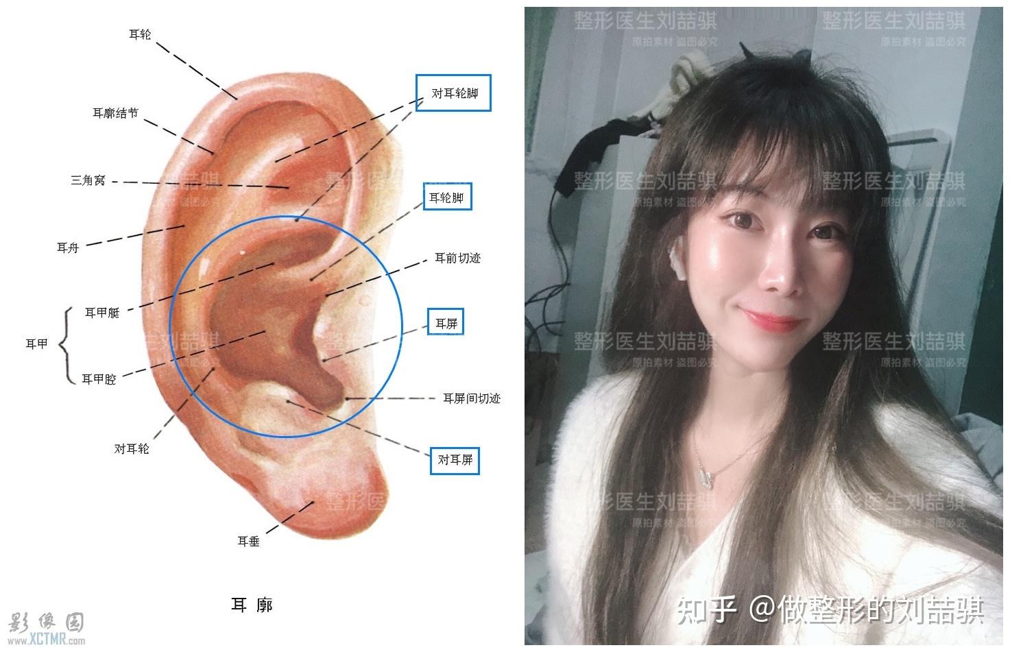 解答那些年關於耳軟骨切取前後的聳人傳聞