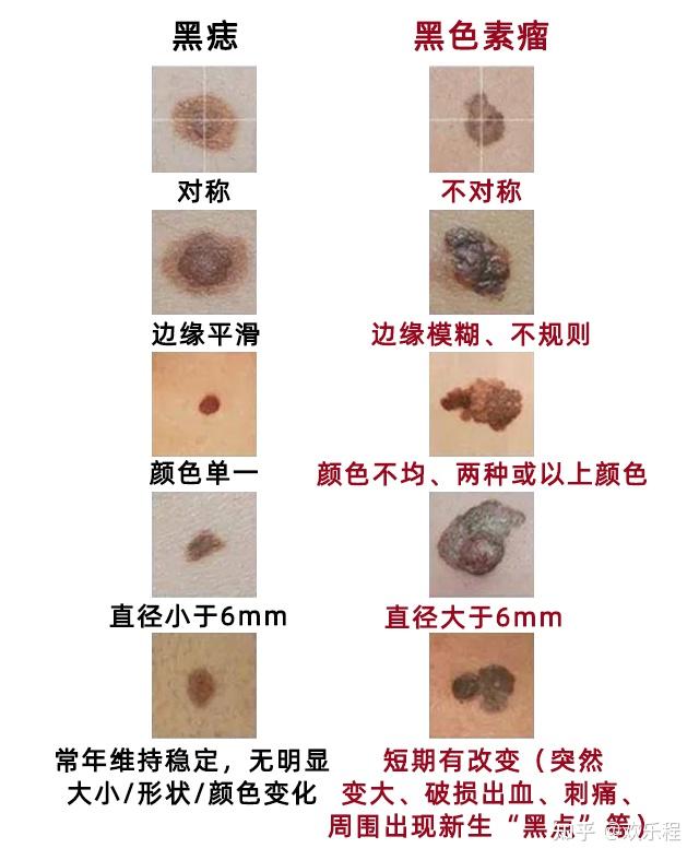 这样的黑痣可能是黑色素瘤，谨记这5点，避免悲剧！ - 知乎