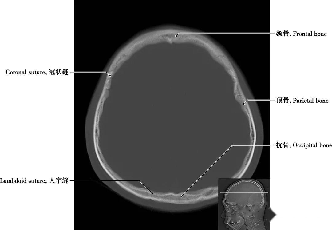 详细标注版！颅脑CT正常解剖图谱 - 知乎