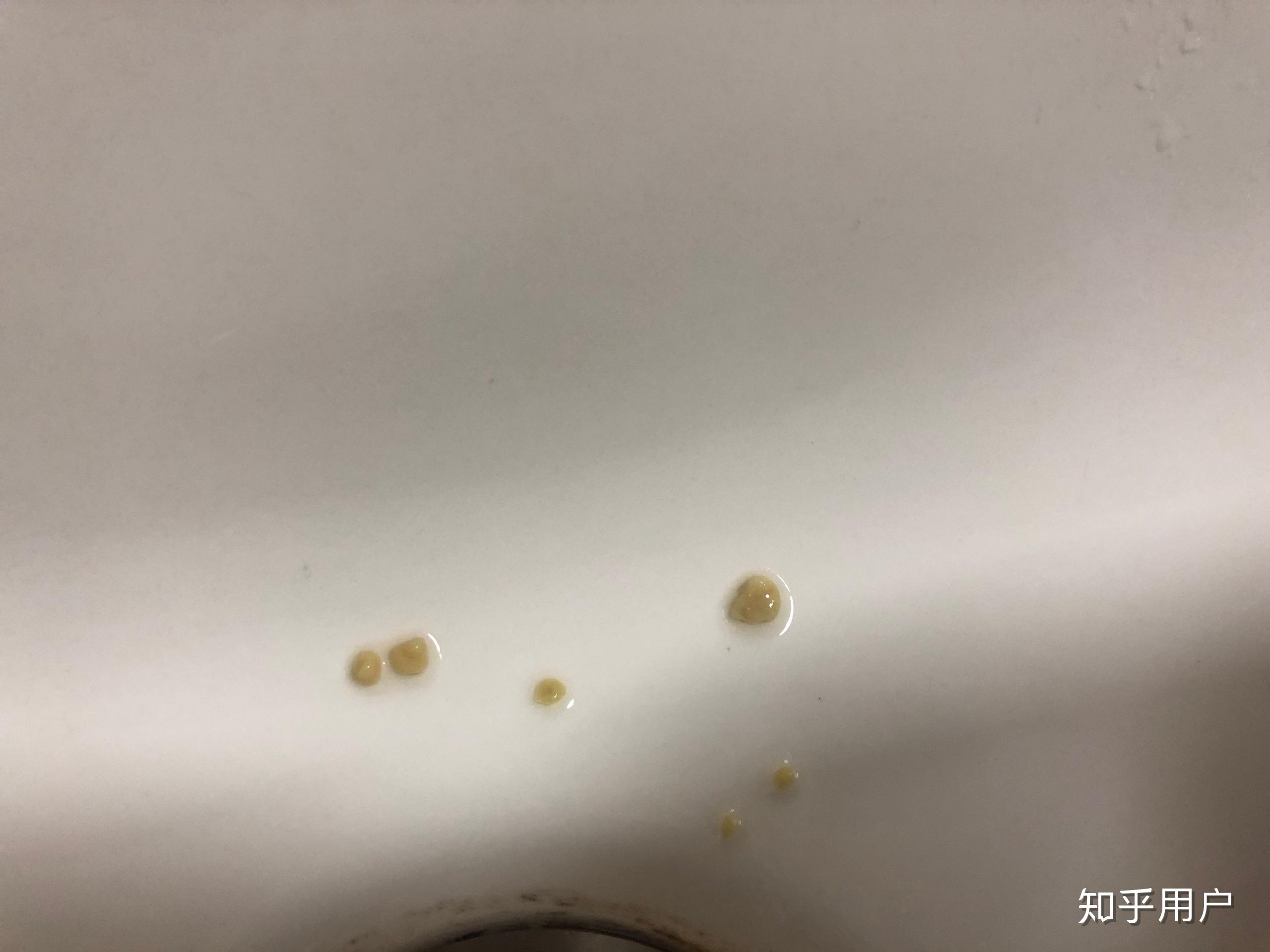 做了扁桃体摘除手术,怎么过了一阵子又有了这种颗粒?