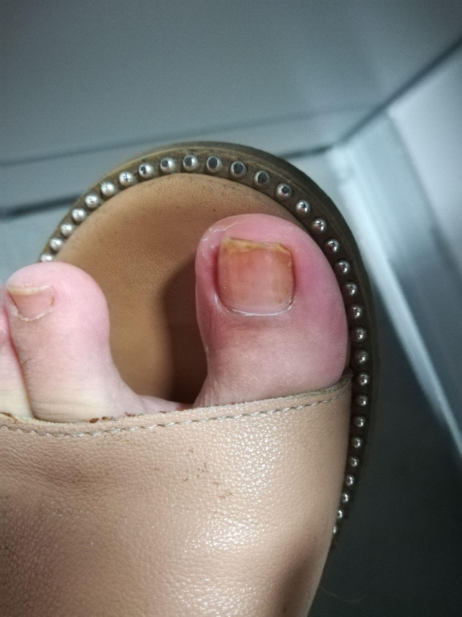 嵌甲甲沟炎怎么根治