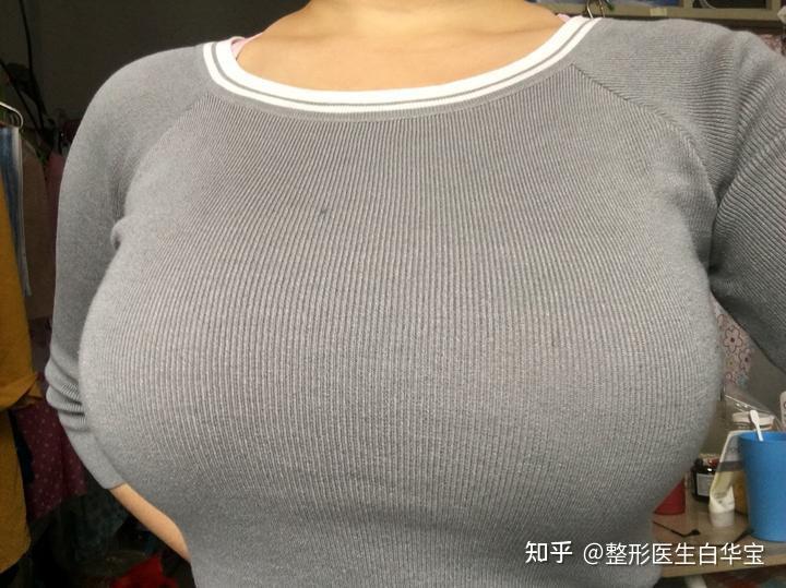 圆锥型:乳房前突的长度大于乳房基底部周围半径(乳房前突约为6～7厘米