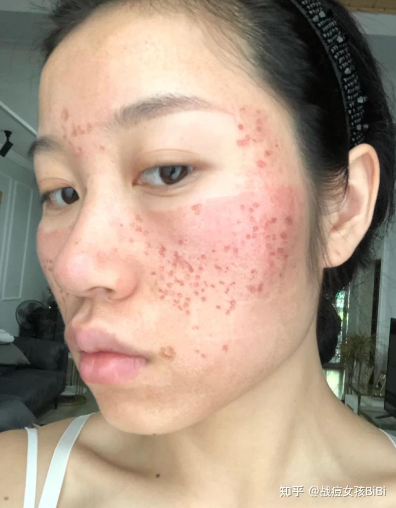 co2点阵激光治第一次痘坑治疗全记录