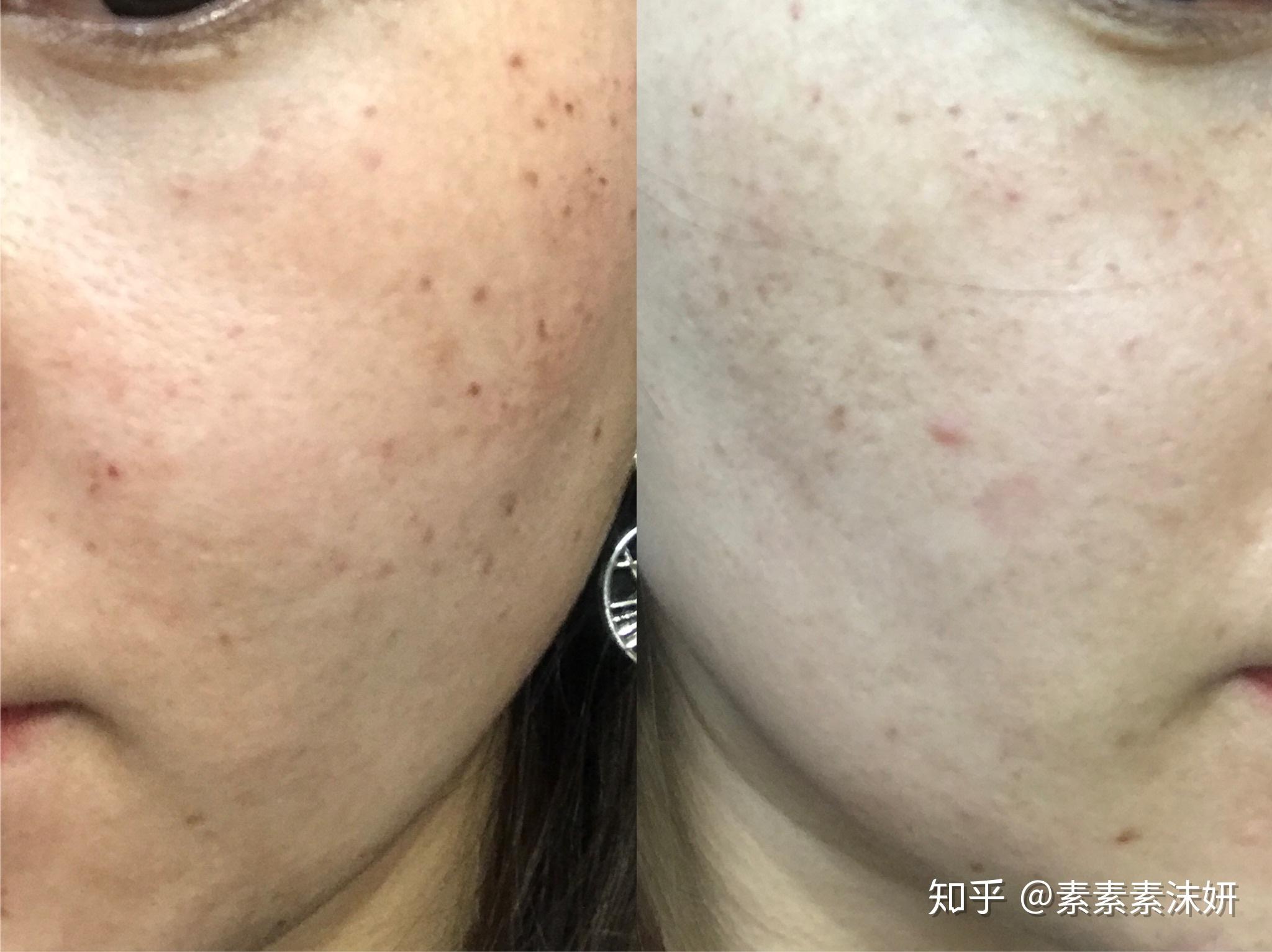 超皮秒祛晒斑黄褐斑中胚层英诺小棕瓶治疗美白祛黄