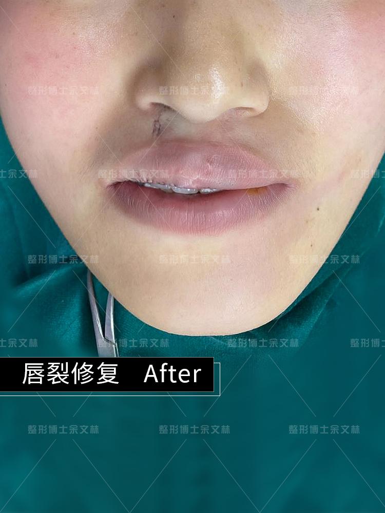 【案例分析】双侧唇裂的小姐姐鼻唇均有畸形,选择只修复唇部