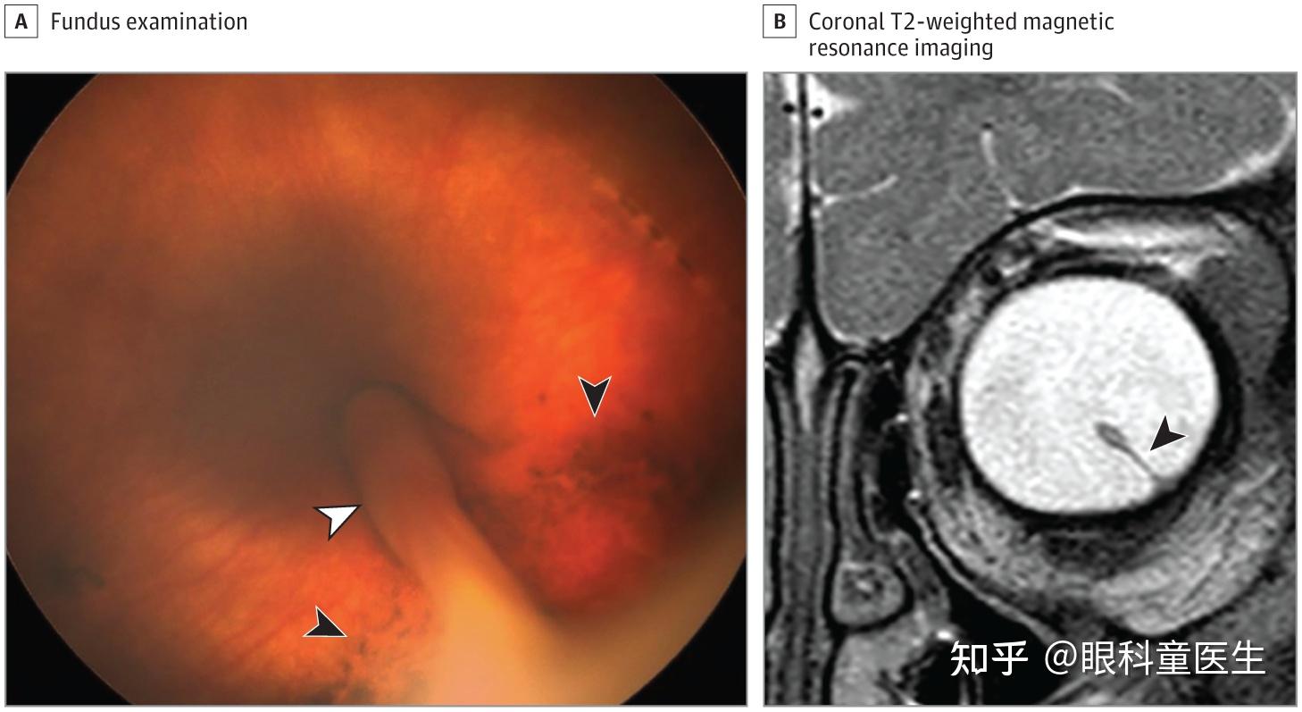 先天性视网膜异常4先天性视网膜皱襞