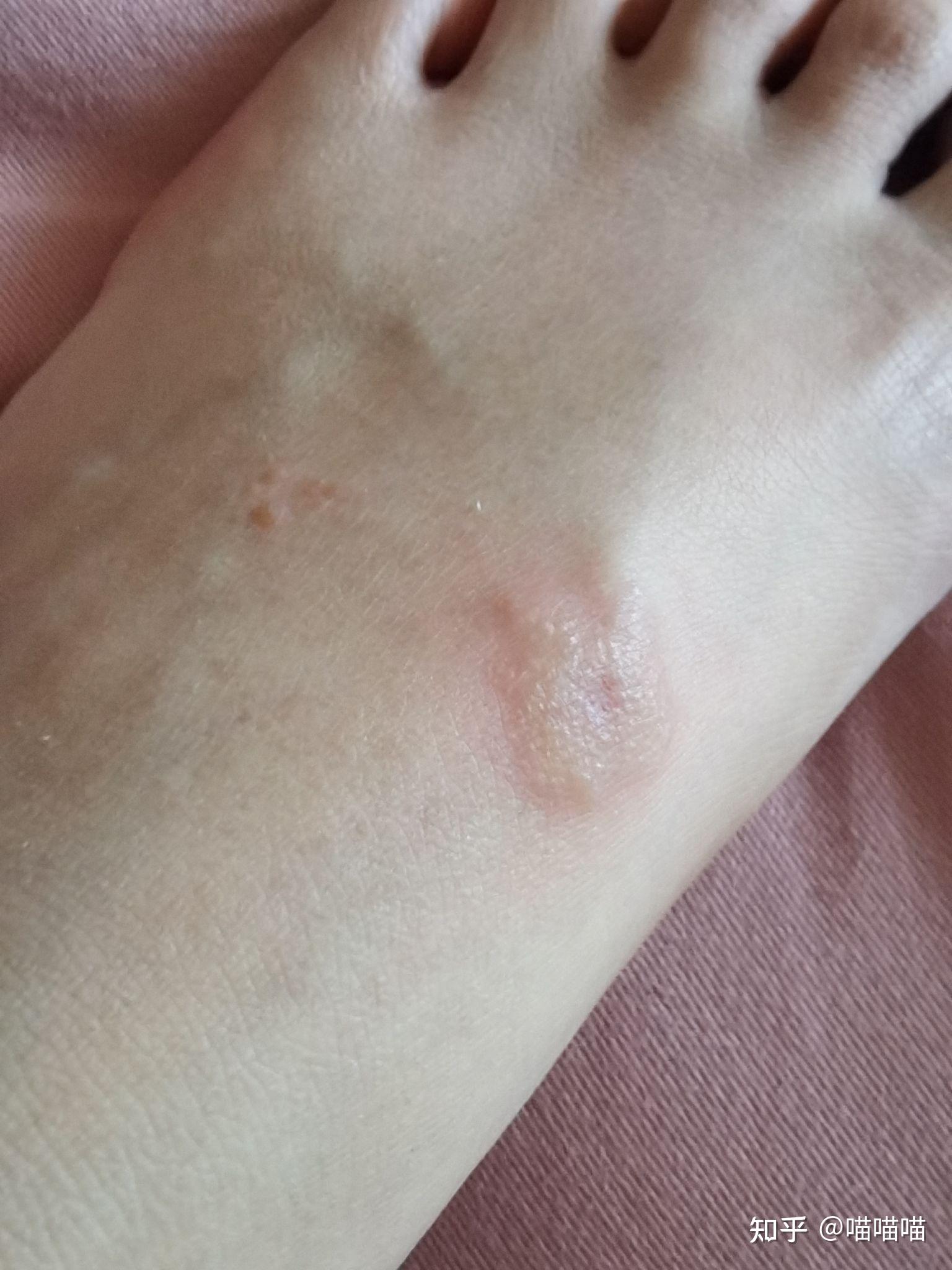 我不知道被什么虫子咬了脚踝很痒出现了红色的肿块中间还有个透明凸起