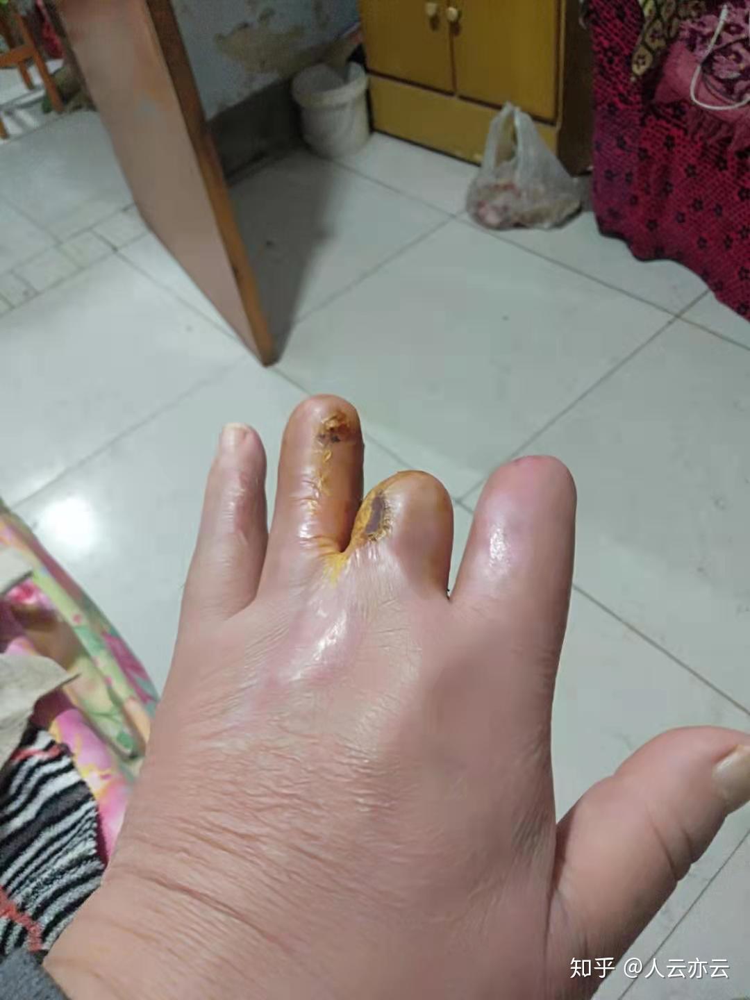 家里人年龄59岁去小厂子打工不慎被机器挤伤手指部分手指关节截断像