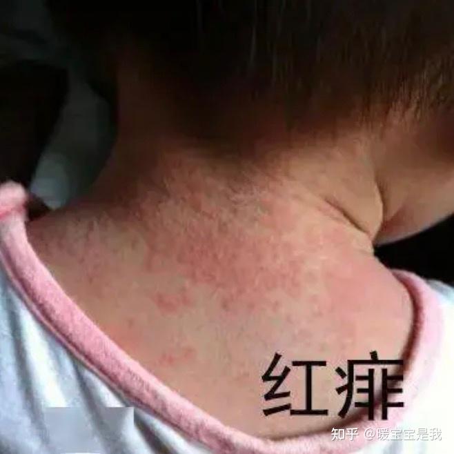 天气转冷了，宝宝还会出热疹吗？宝宝出疹别太大意，对症下药是关键 - 知乎