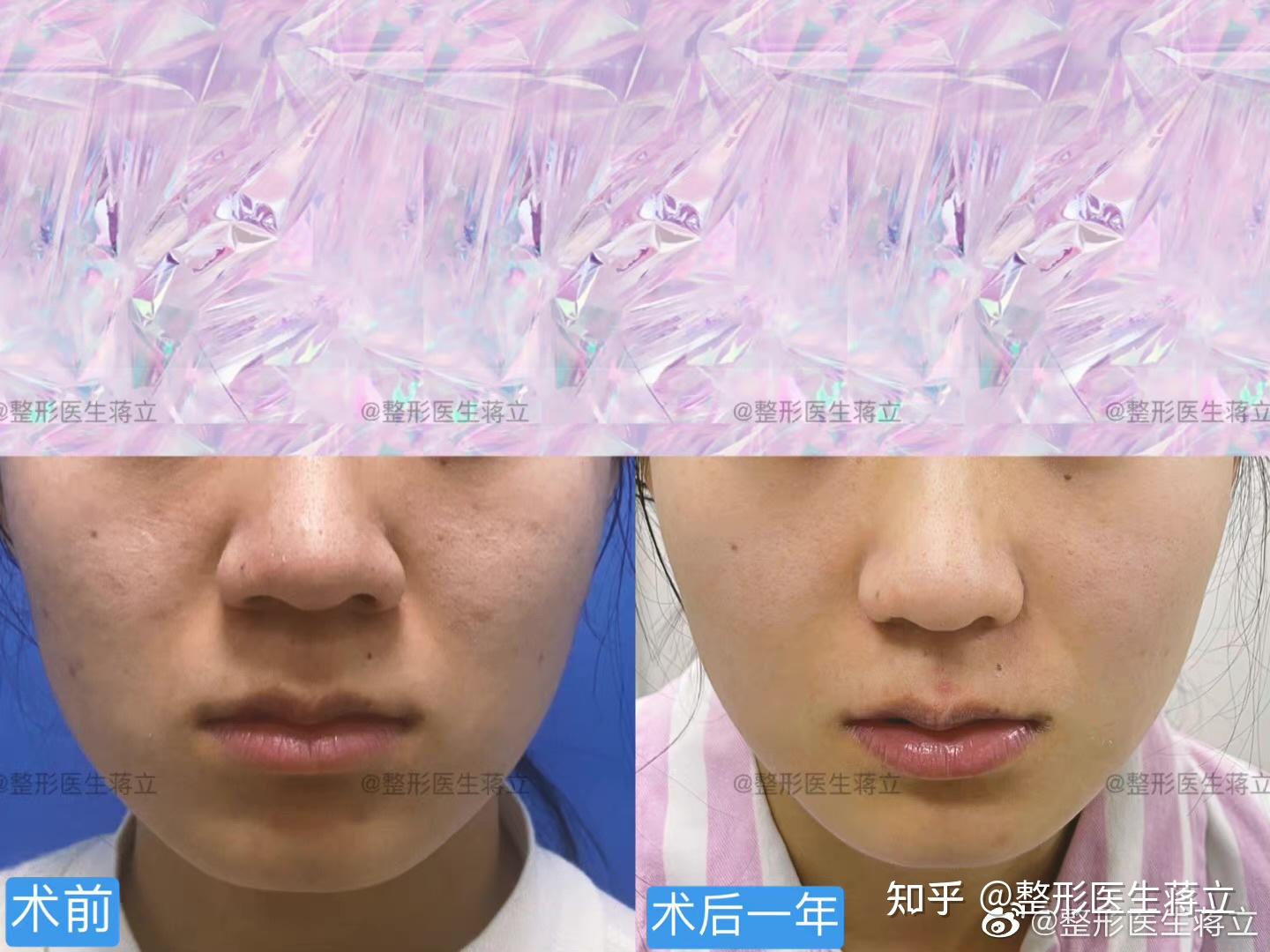 关于我在杭州做濡白天使填充鼻基底的恢复记录 - 知乎