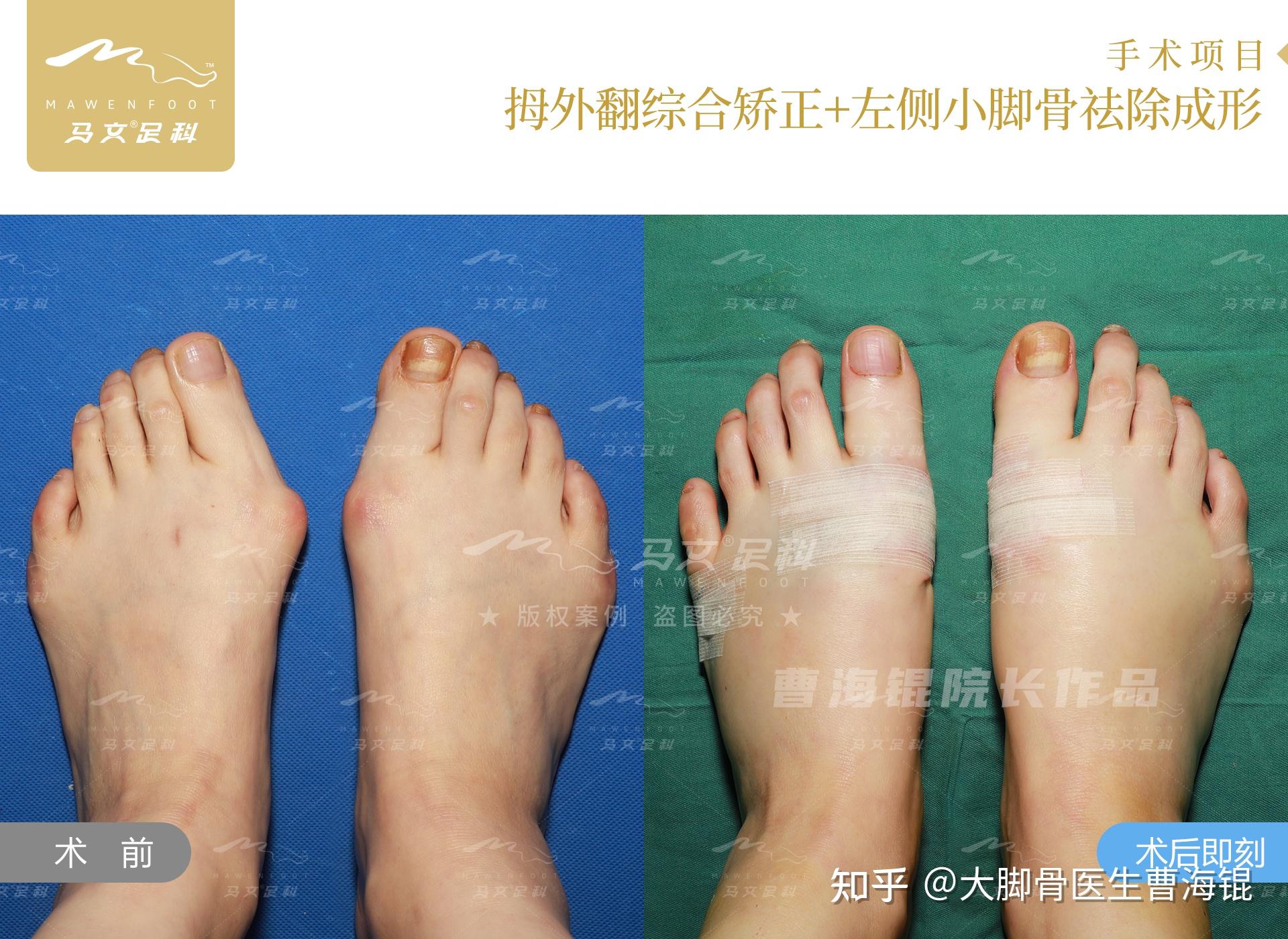 关于拇指外翻的一些问题和小纠结