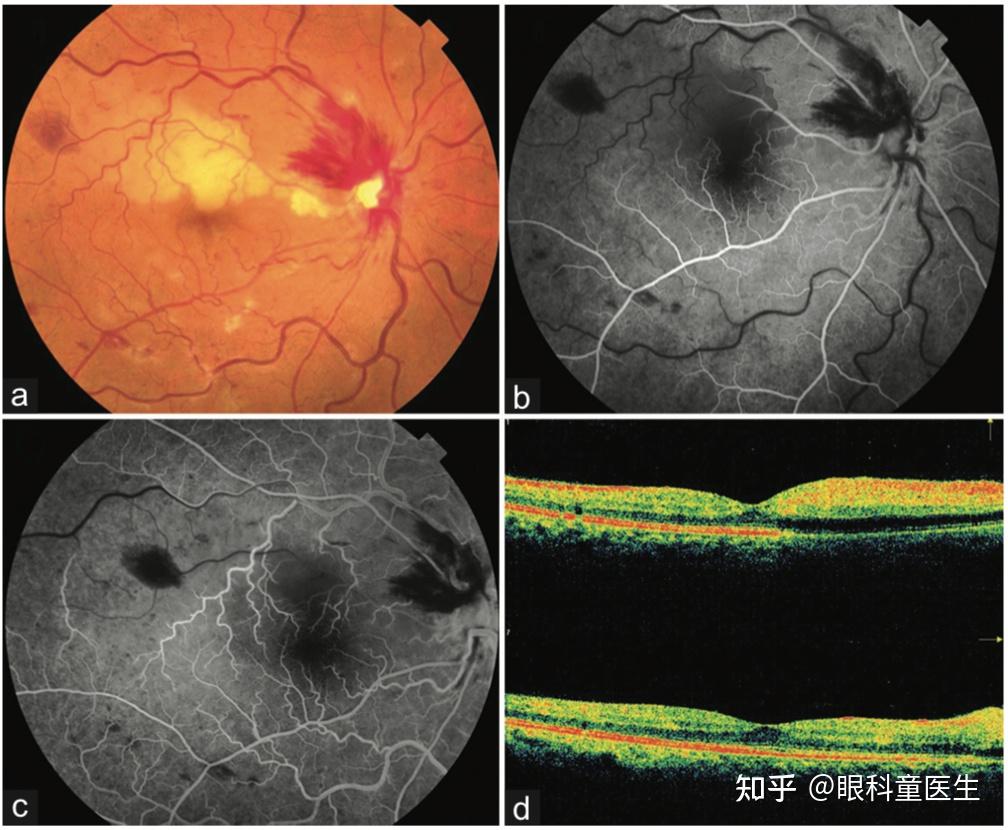视网膜血管性疾病——1、视网膜静脉阻塞 知乎 