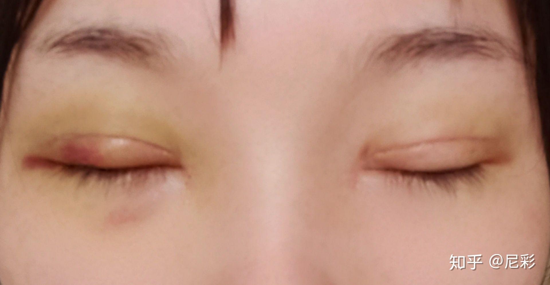 北京双眼皮修复半年恢复过程 一天比一天自然！ - 知乎
