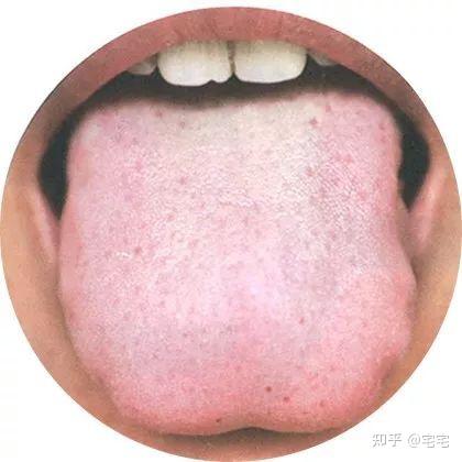 史上最全!高清舌诊图谱,看舌头知健康,人手一份! - 知乎