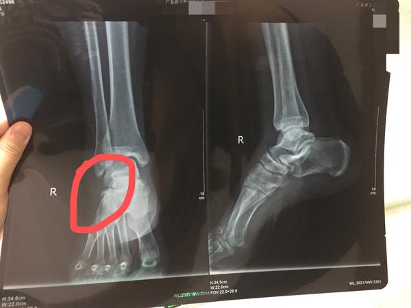 记录右踝骨撕脱性骨折15天能走路