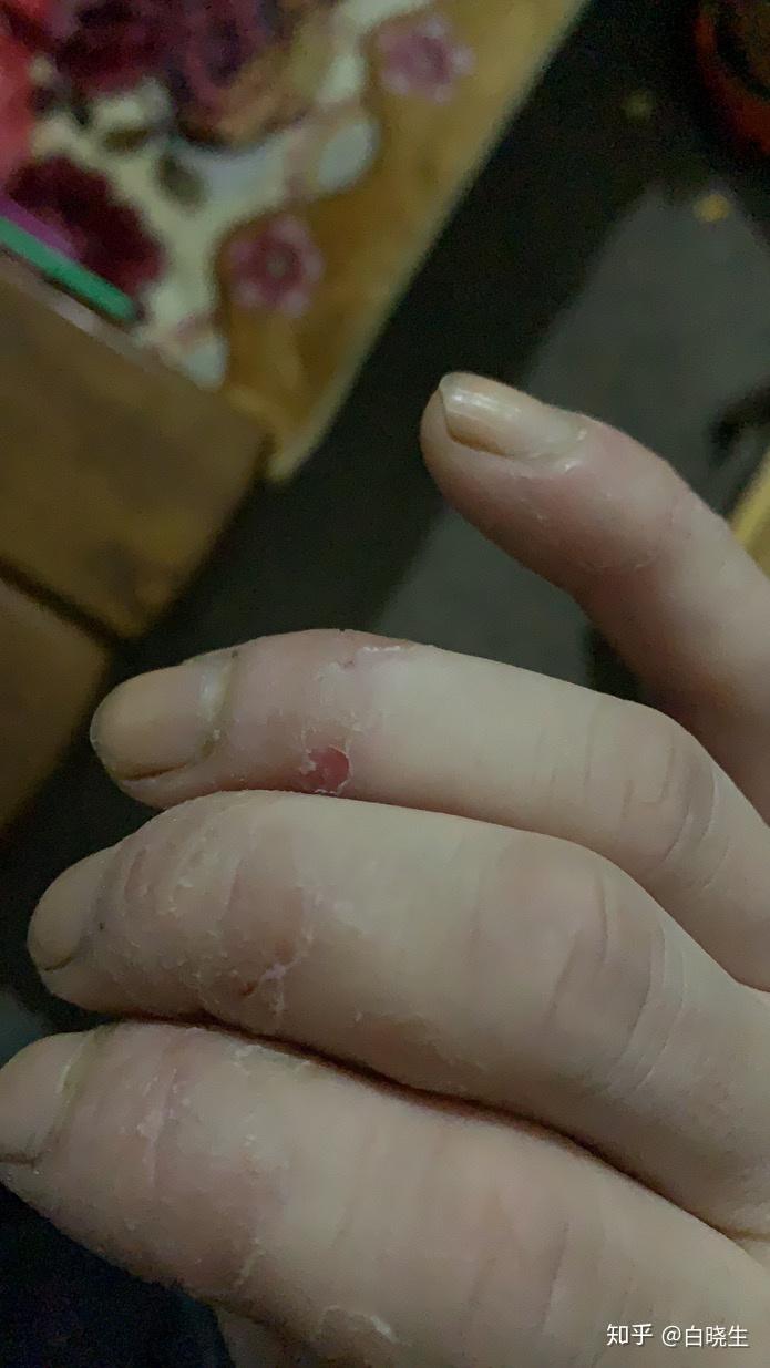 手指开裂脱皮严重