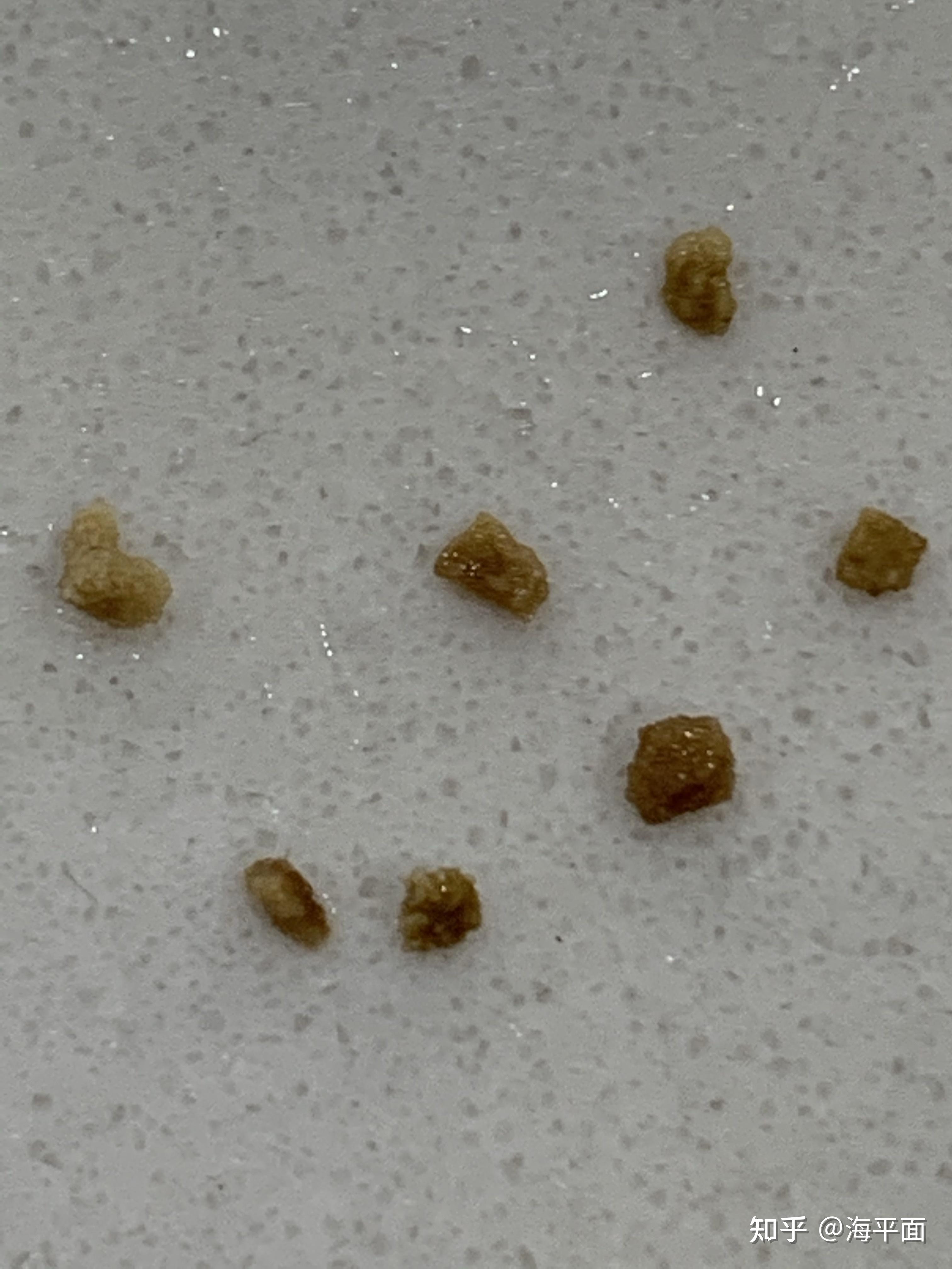 输尿管支架取出后结石排出频率增加有相同的经历吗