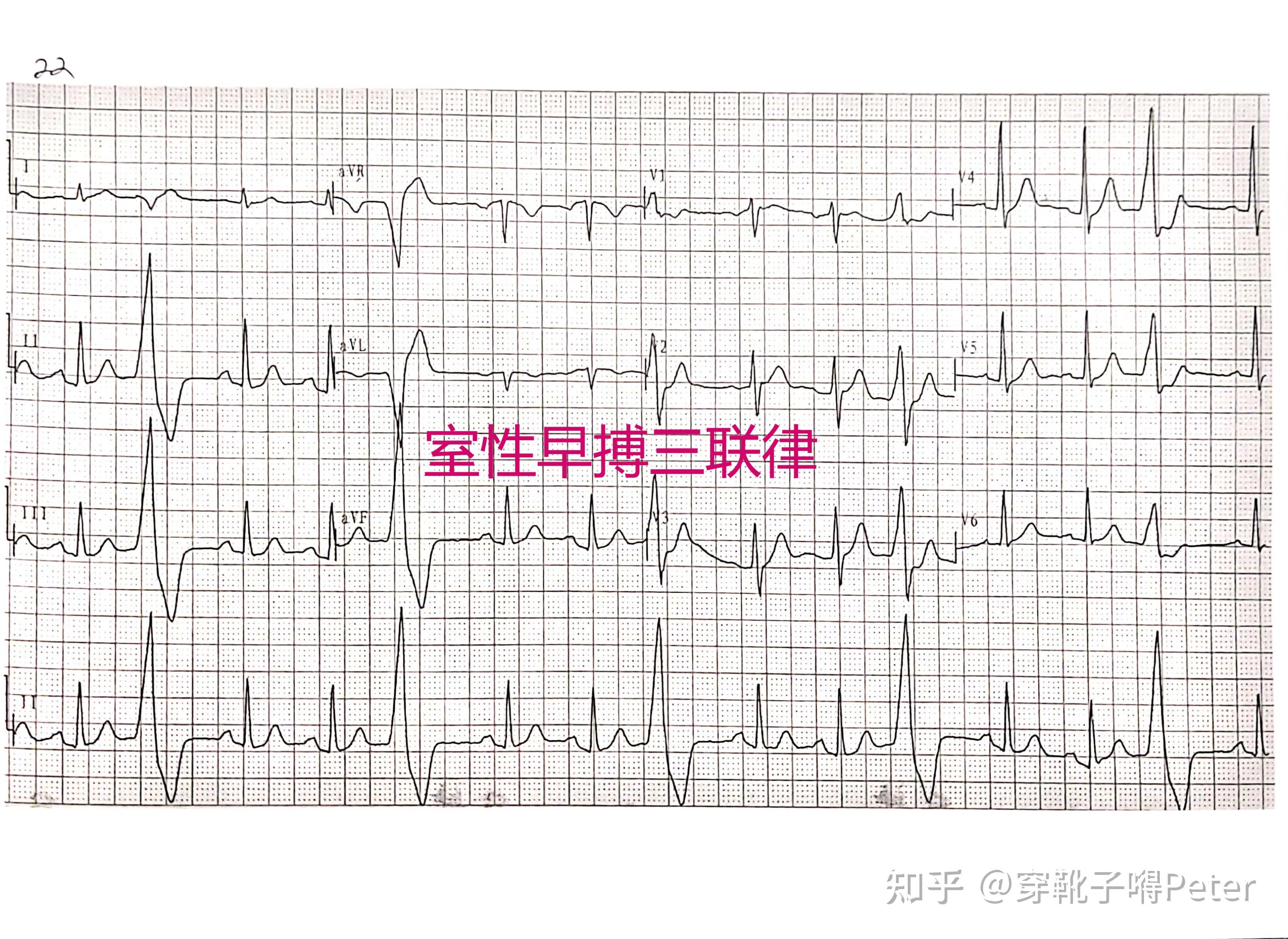 60种常见心电图一览第三篇室性心率失常