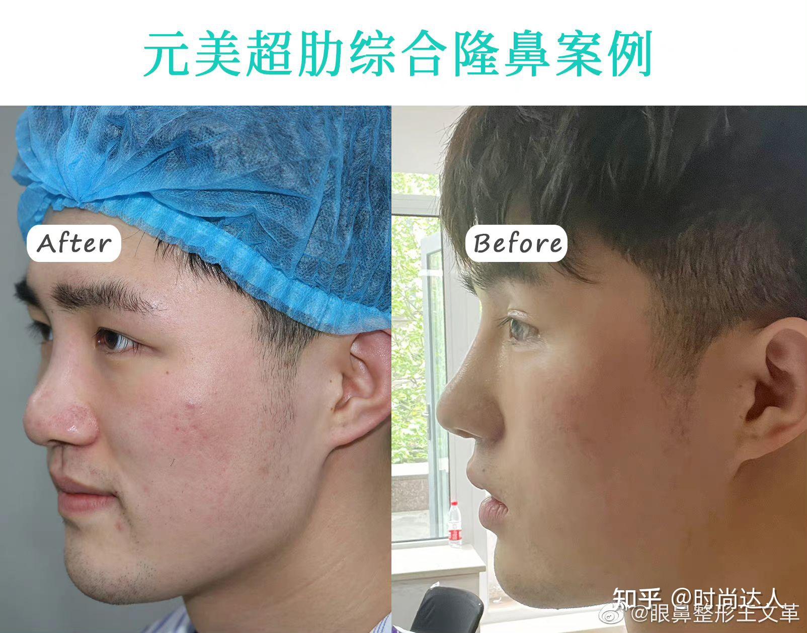 男士肋软骨隆鼻效果分享