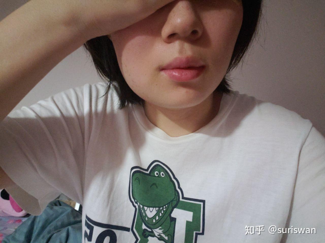 拔水平阻生智齿,术后第二天脸肿了,请问几天能消肿?